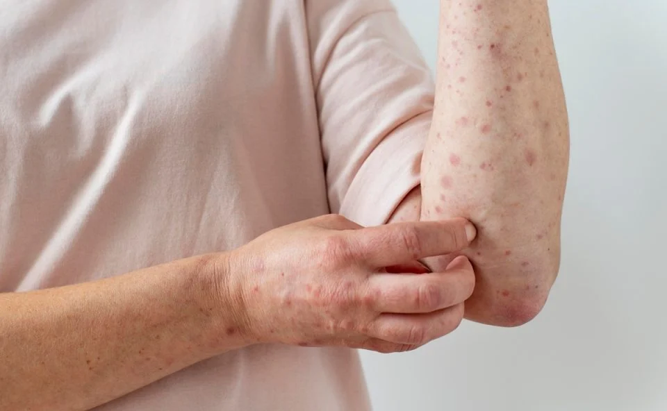 Brasil registra 140 casos de Mpox em 2026; Santa Catarina contabiliza três confirmações