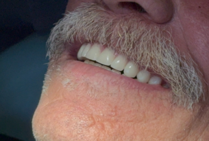 Ibirama realiza primeira entrega de próteses dentárias pelo programa Brasil Sorridente
